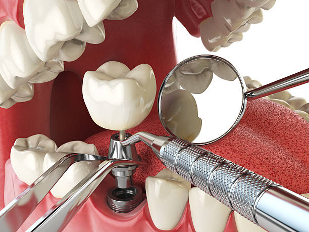 Best Urgent Tooth Repair  in Searles Valley, CA